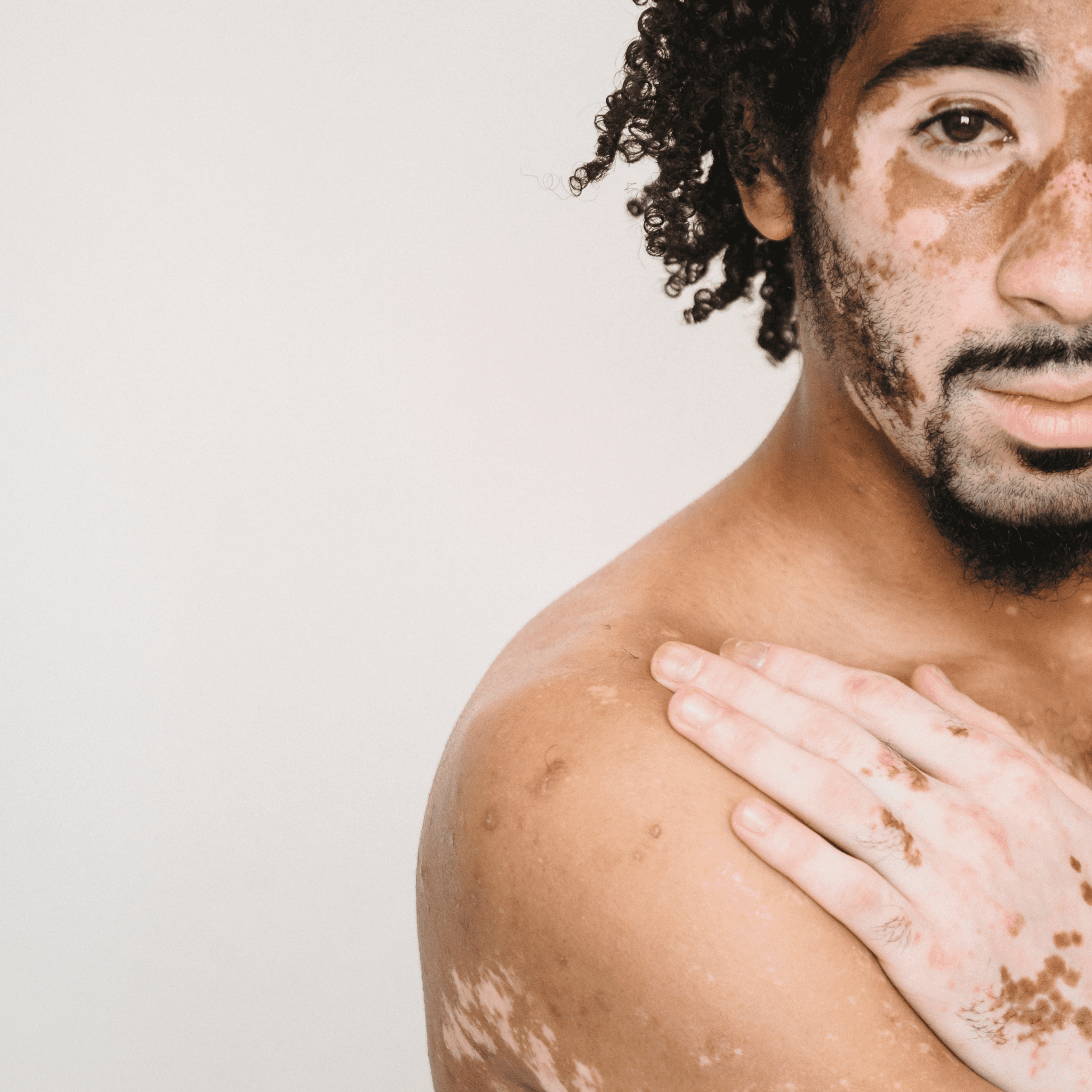 25 de junho: Dia do Vitiligo - Celebre a diversidade da pele